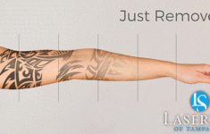 Laser Tattoo Removal Palm Harbor LaserSpa Palm Harbor