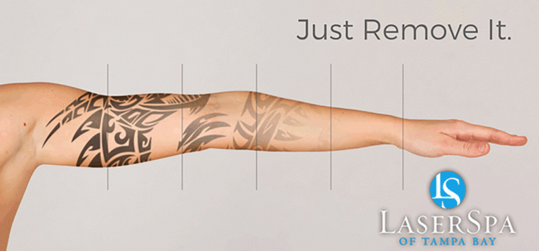 Laser Tattoo Removal Palm Harbor LaserSpa Palm Harbor